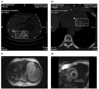Comparative Study on <mark class="highlighted">Iron Content</mark> Detection by Energy Spectral CT and MRI in MDS Patients